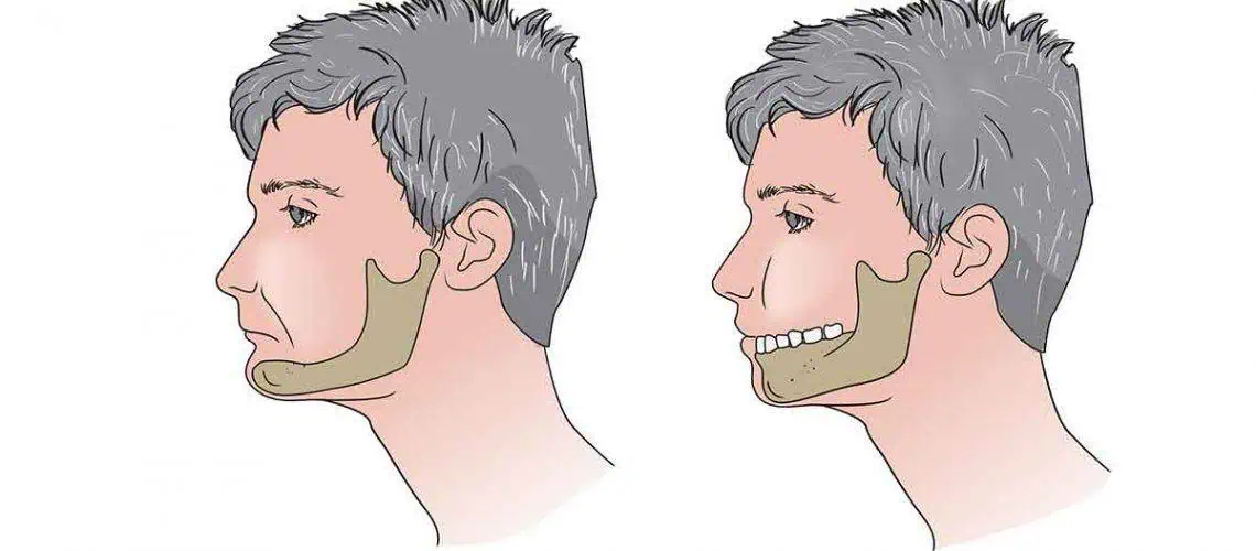 What Happens to Your Face and Jawline When You Lose Teeth