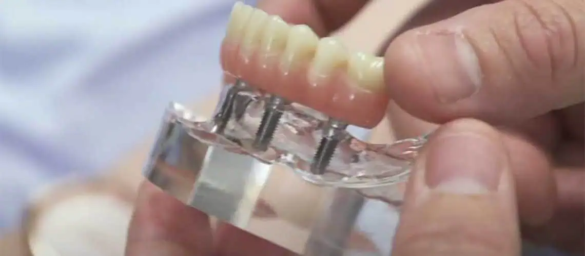 How Many Implants Do You Need to Replace Full Set of Teeth