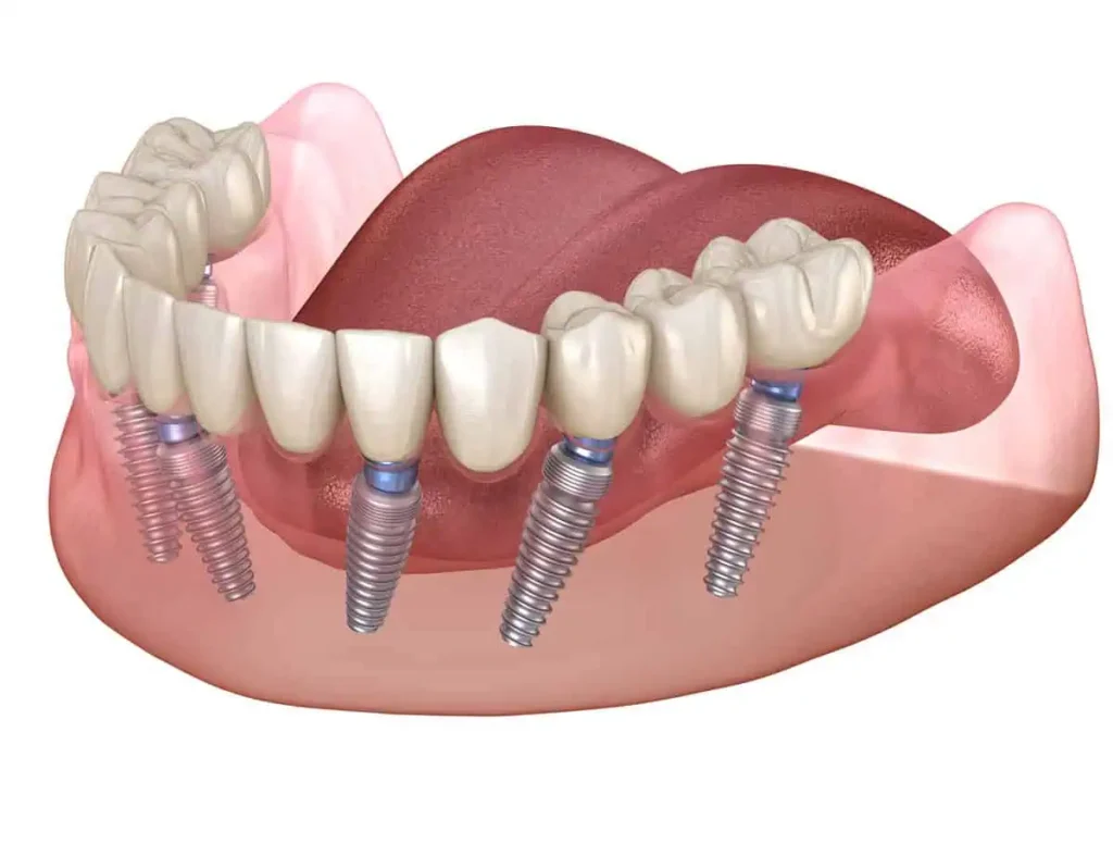 Full Mouth Dental Implants in Kansas City, KS