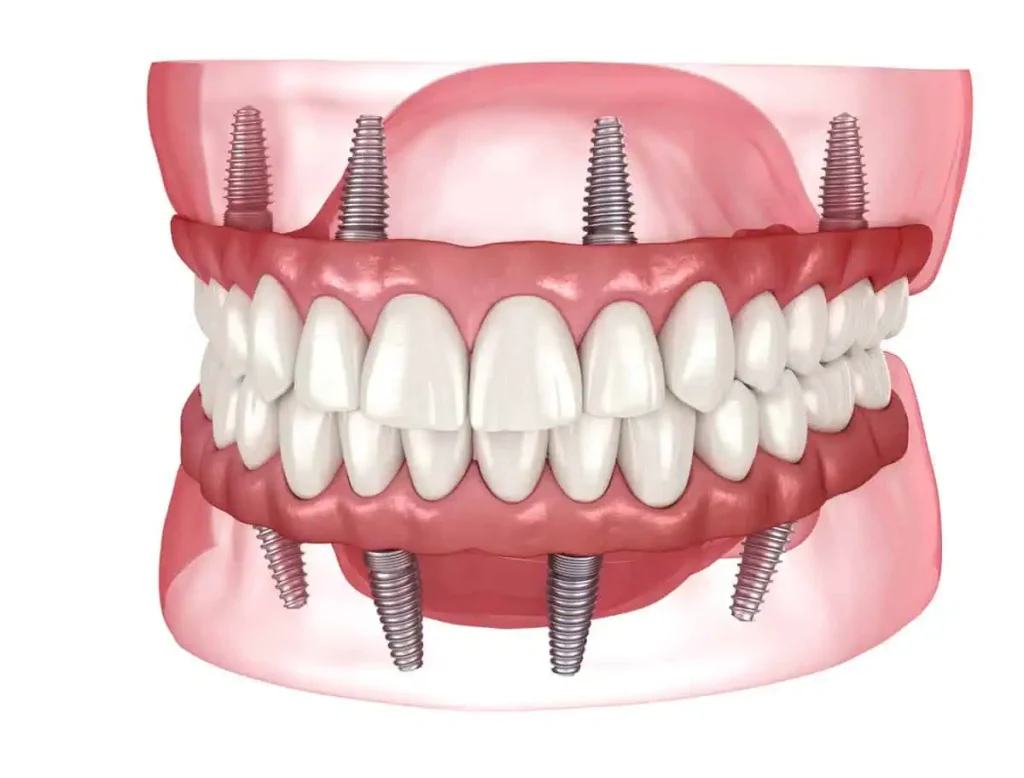 Full Mouth Implants Kanas City, KS at Gordon Dental Implants and Cosmetics
