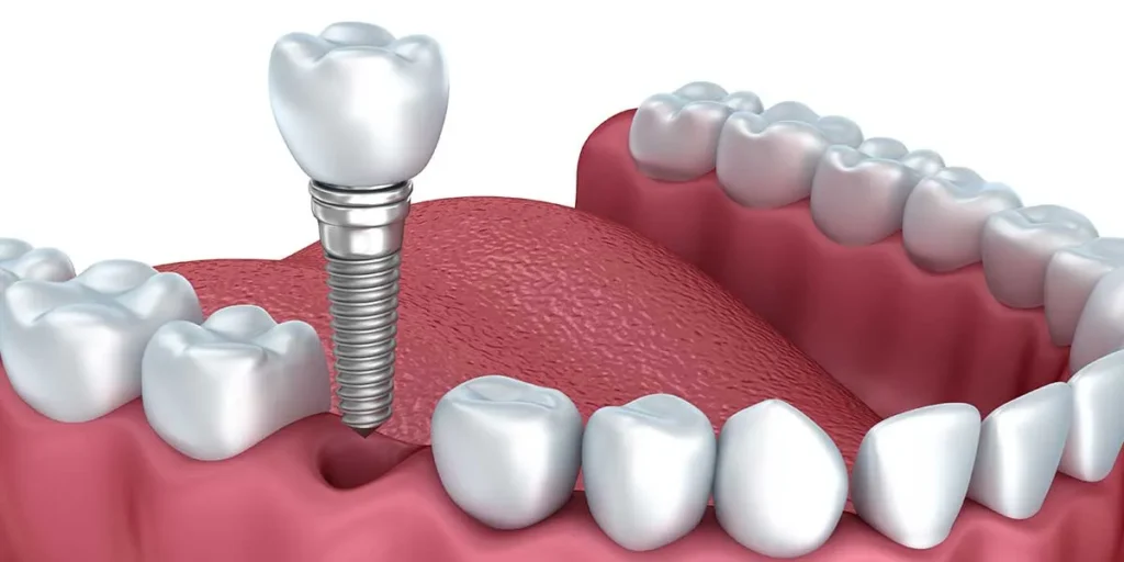 Single tooth dental implant procedure in Kansas City at Gordon Dental Implants and Cosmetics