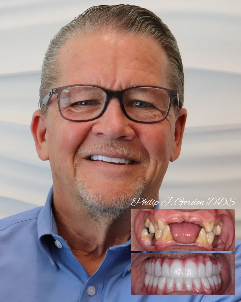Smile transformation after All-on-Four Dental Implants at Gordon Dental Implants & Cosmetics – featuring complete set of natural-looking, fixed teeth.