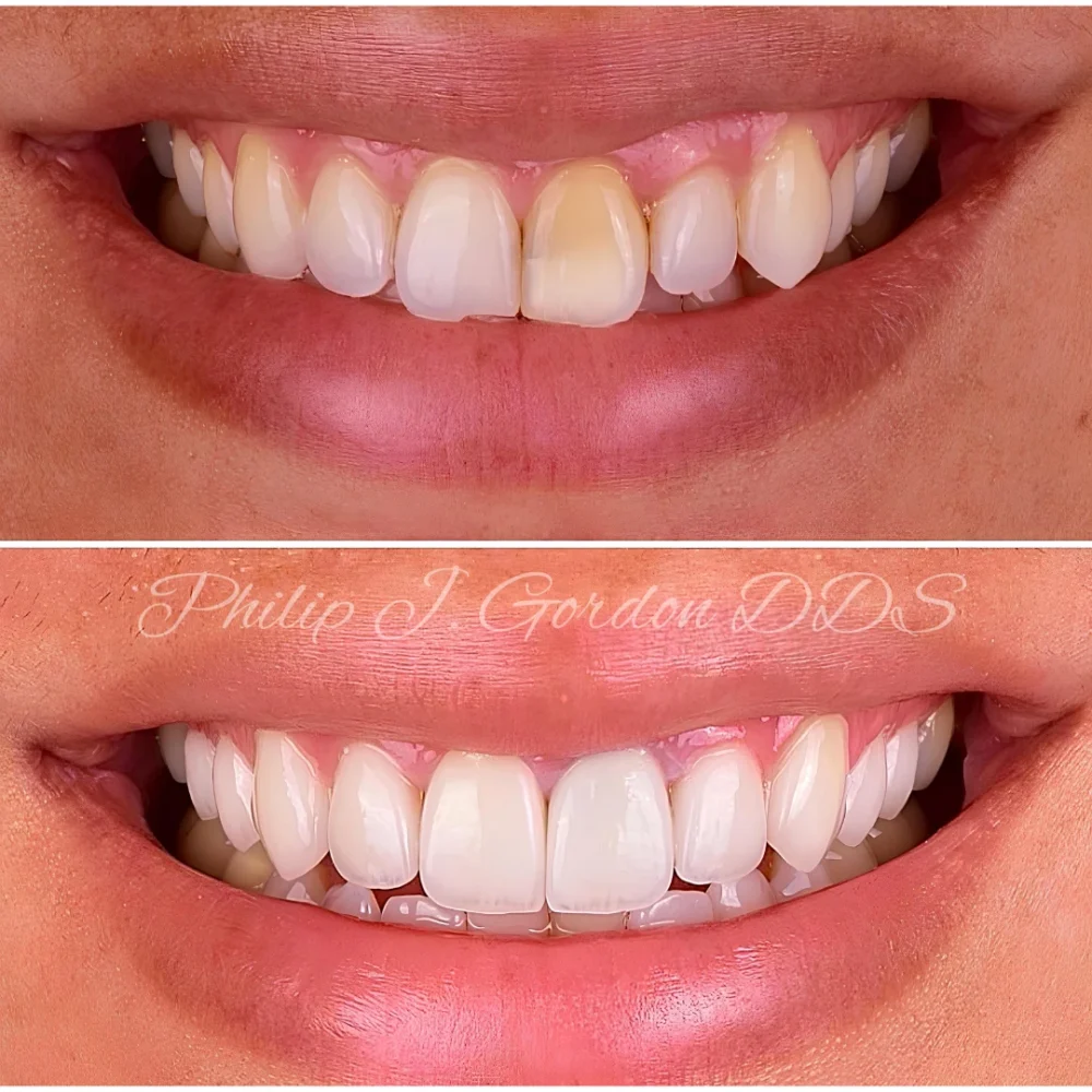 Transformed smile with Porcelain Veneers at Gordon Dental Implants & Cosmetics – showcasing natural-looking, white, and perfectly aligned teeth.