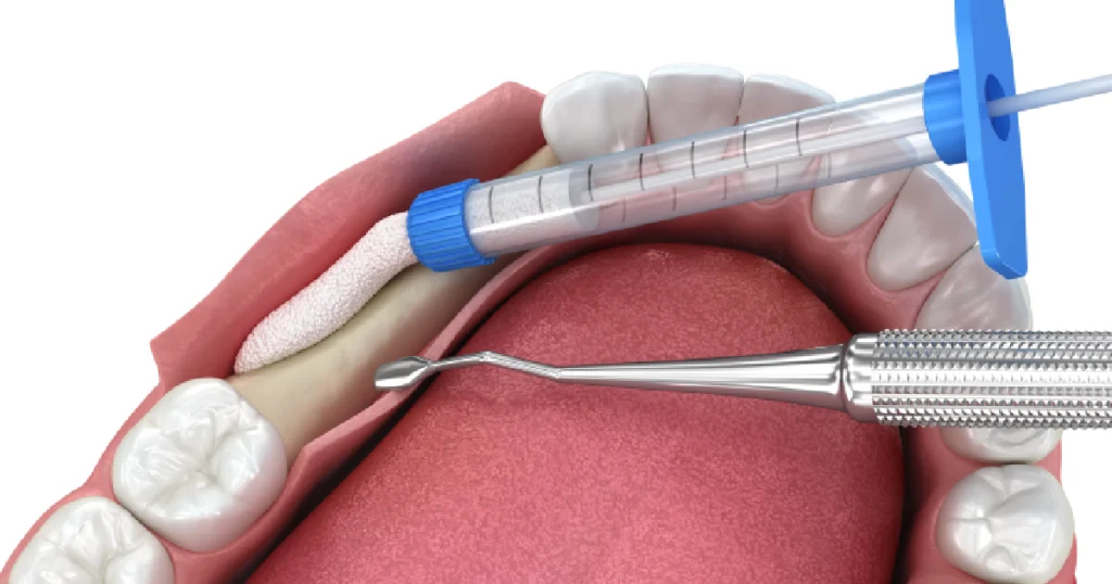 3D illustration of dental bone graft placement for implant in Kansas City