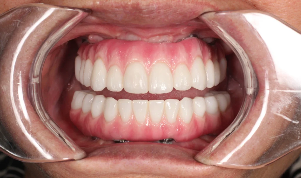 Smile makeover for broken and failing dental implants at Gordon Dental Implants and Cosmetics in Kansas City.