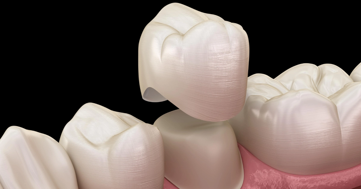 Detailed 3D illustration of a porcelain dental crown being placed over a prepared tooth stump, representing Full-Mouth Crowns in Kansas City.