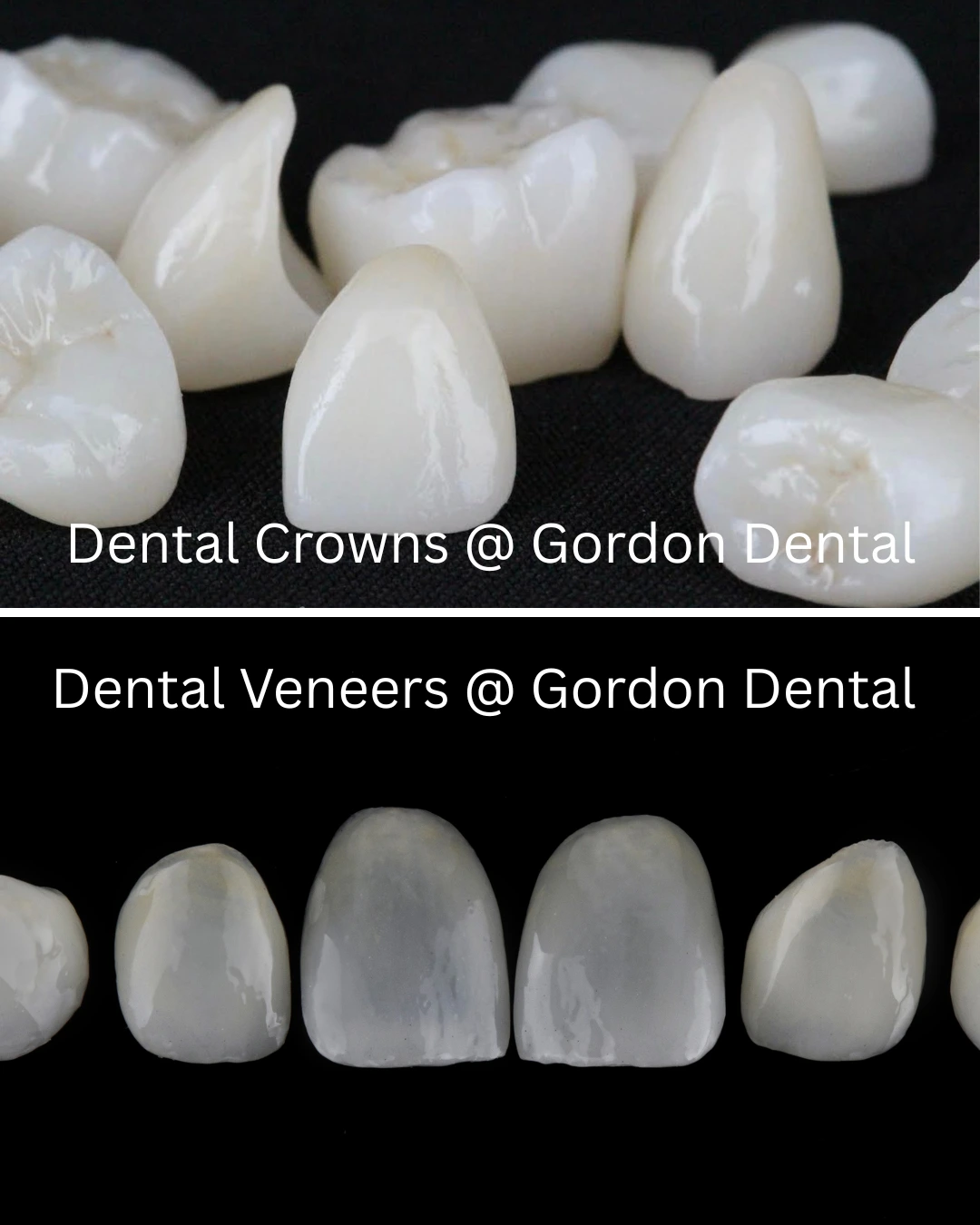 Porcelain Veneers vs. Crowns Choose the Best Option for Your Smile