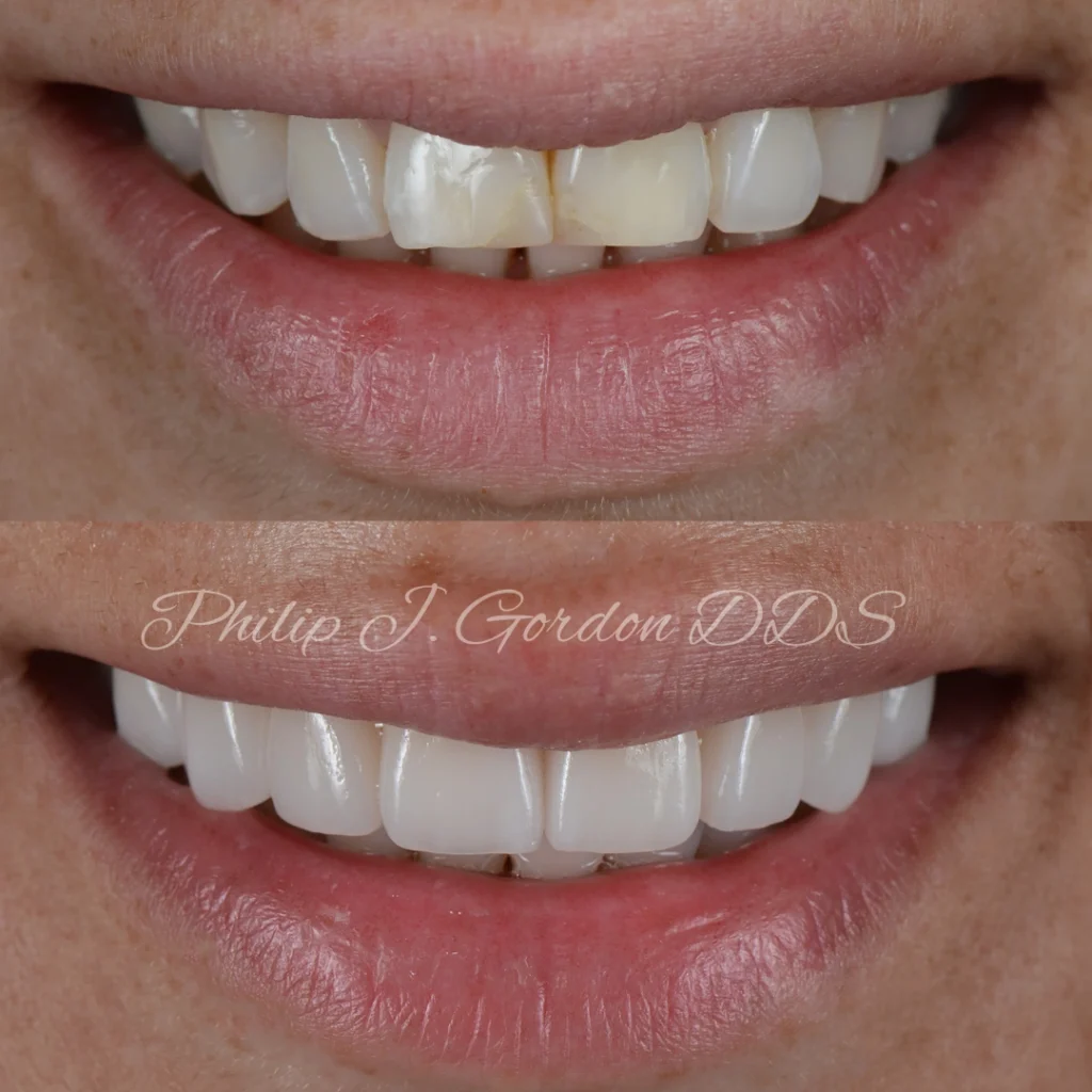 Close-up of a patient’s smile with porcelain veneers at Gordon Dental Implants and Cosmetics in Kansas City