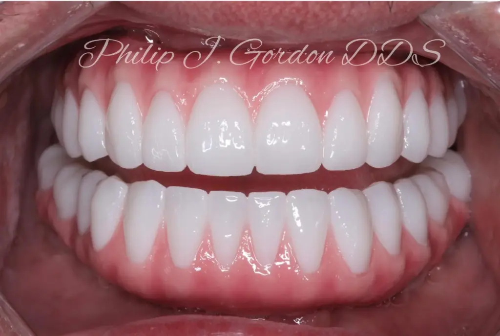 Porcelain Veneers for a Smile Makeover at Gordon Dental Implants and Cosmetics in Kansas City