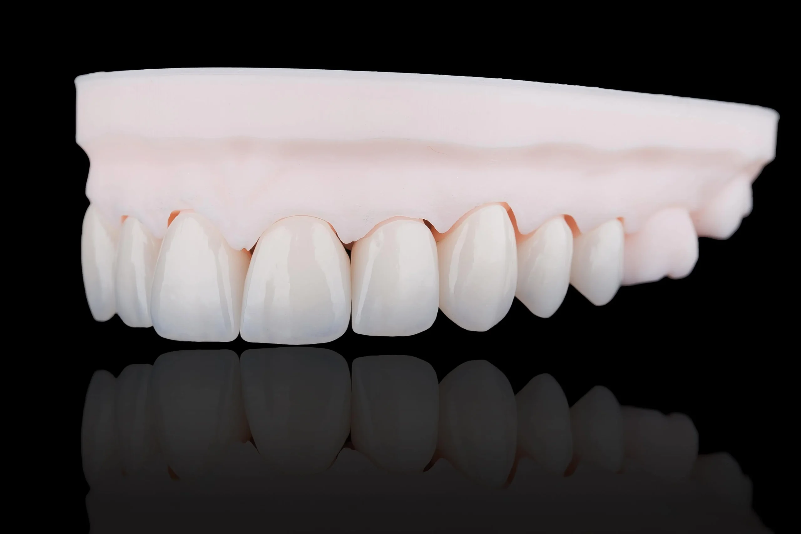 Porcelain Veneers for a Smile Makeover at Gordon Dental Implants and Cosmetics in Kansas City