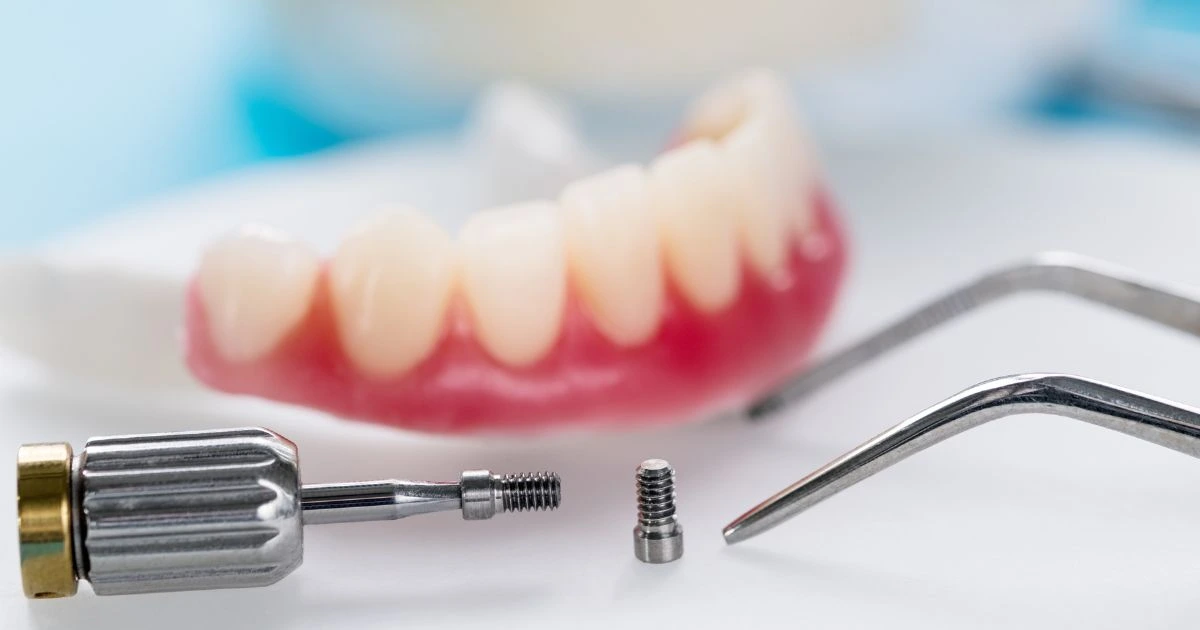 Close-up of dental implant components (screw and tool) with a dental model in the background, representing implant replacement options.