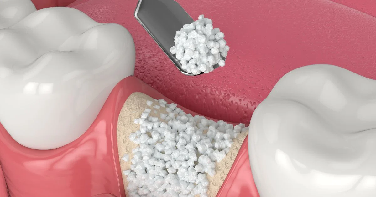 Dr. Philip J. Gordon at Gordon Dental Implants and Cosmetics consulting with a patient about their dental bone grafting and implant plan in Kansas City