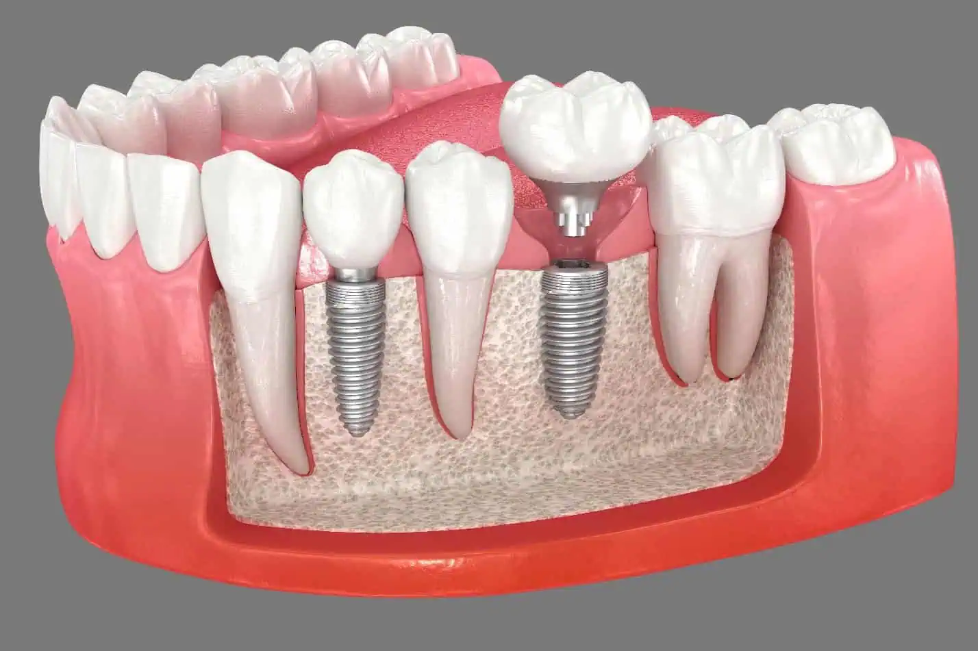 Two Front Dental Implants & Smile Makeover in Kansas City