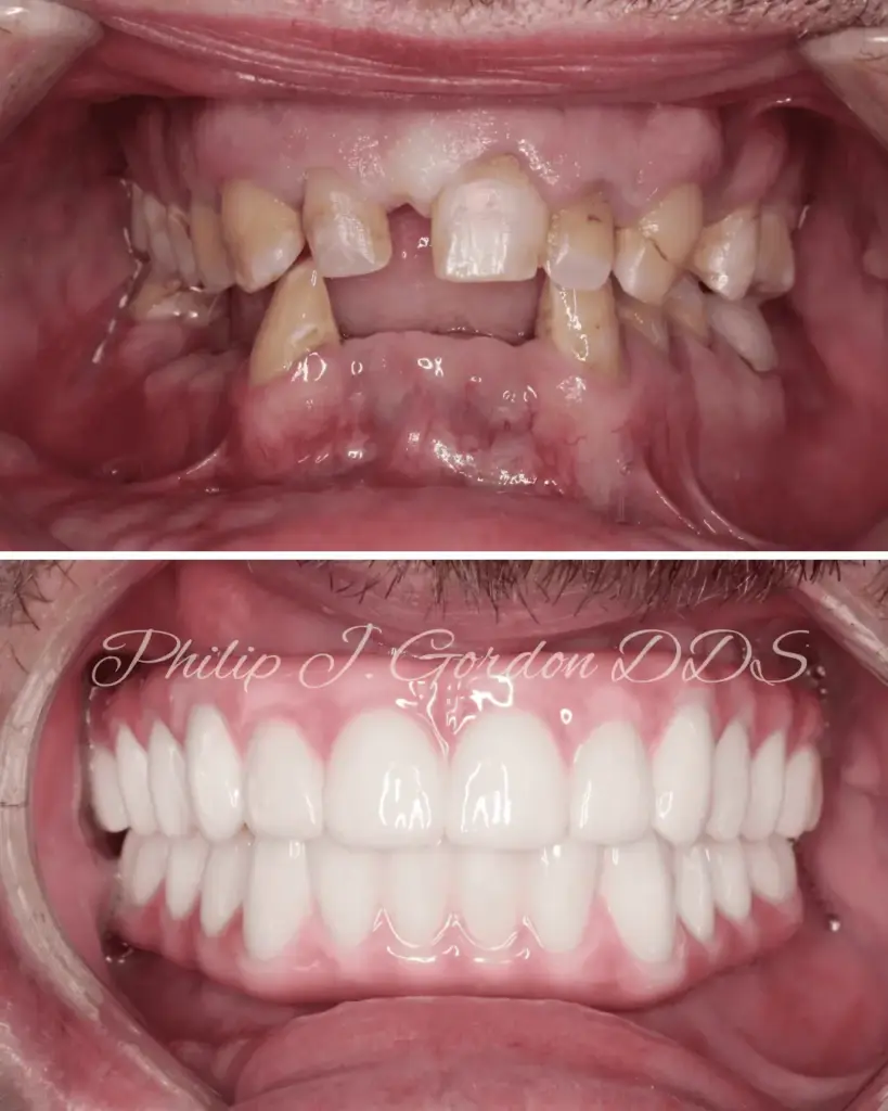 Zirconia implant bridge for full-mouth dental implants in Kansas City