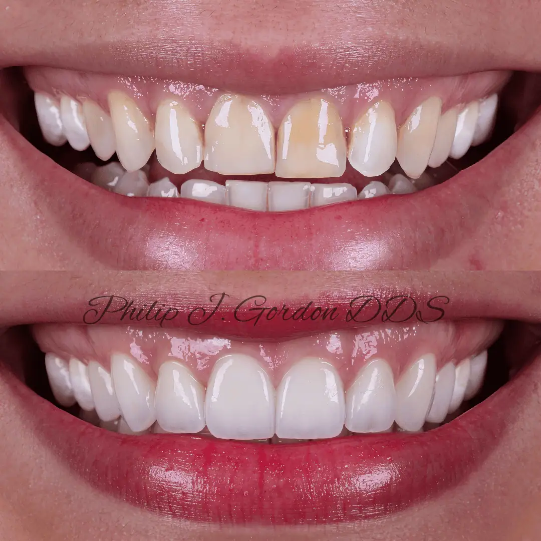 The Art of the Porcelain Veneer Smile Makeover in Kansas City