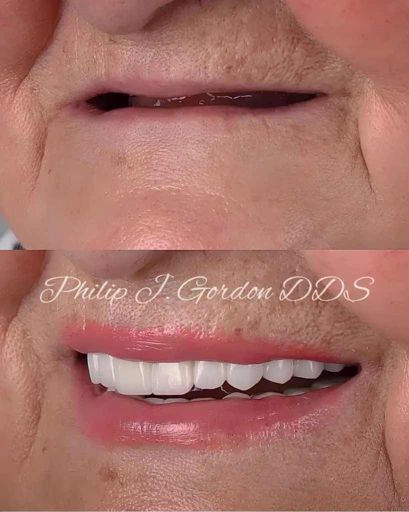 Porcelain Veneers in Kansas City: The Art of Expert Smile Design