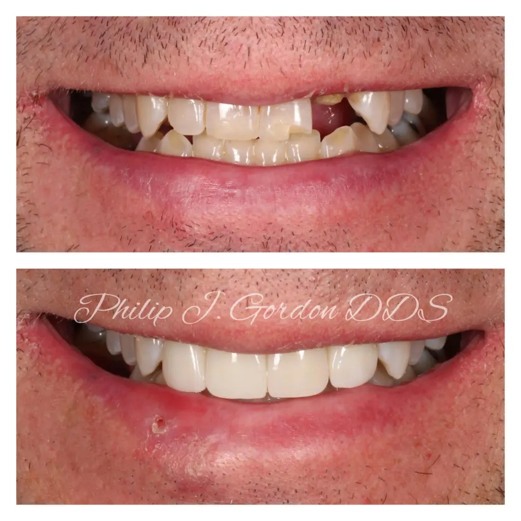 Broken Front Tooth Replaced With a Dental Implant and Cosmetic Crowns in Kansas City