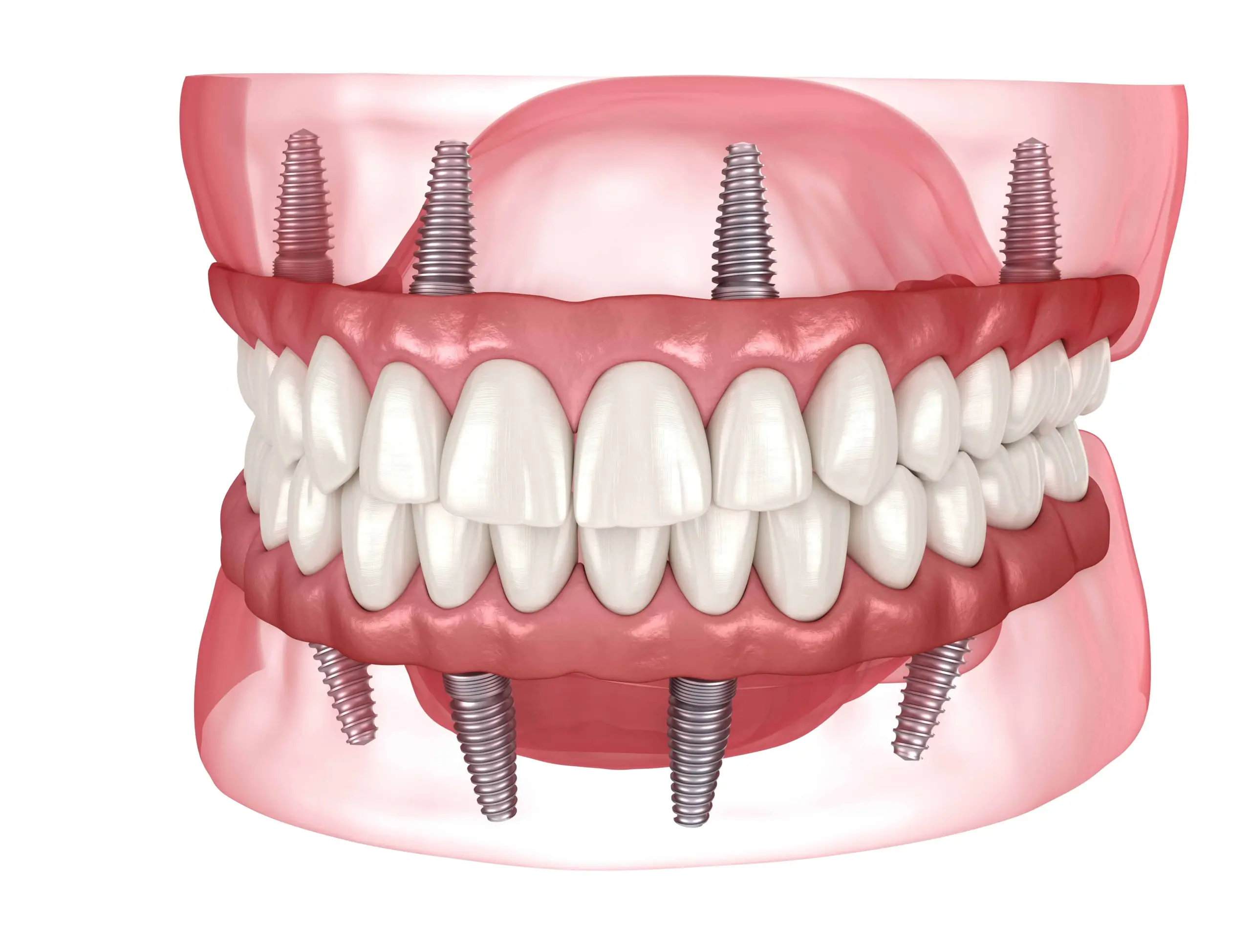 Full Mouth All-on-4 Dental Implants in Kansas City for Smile Transformation