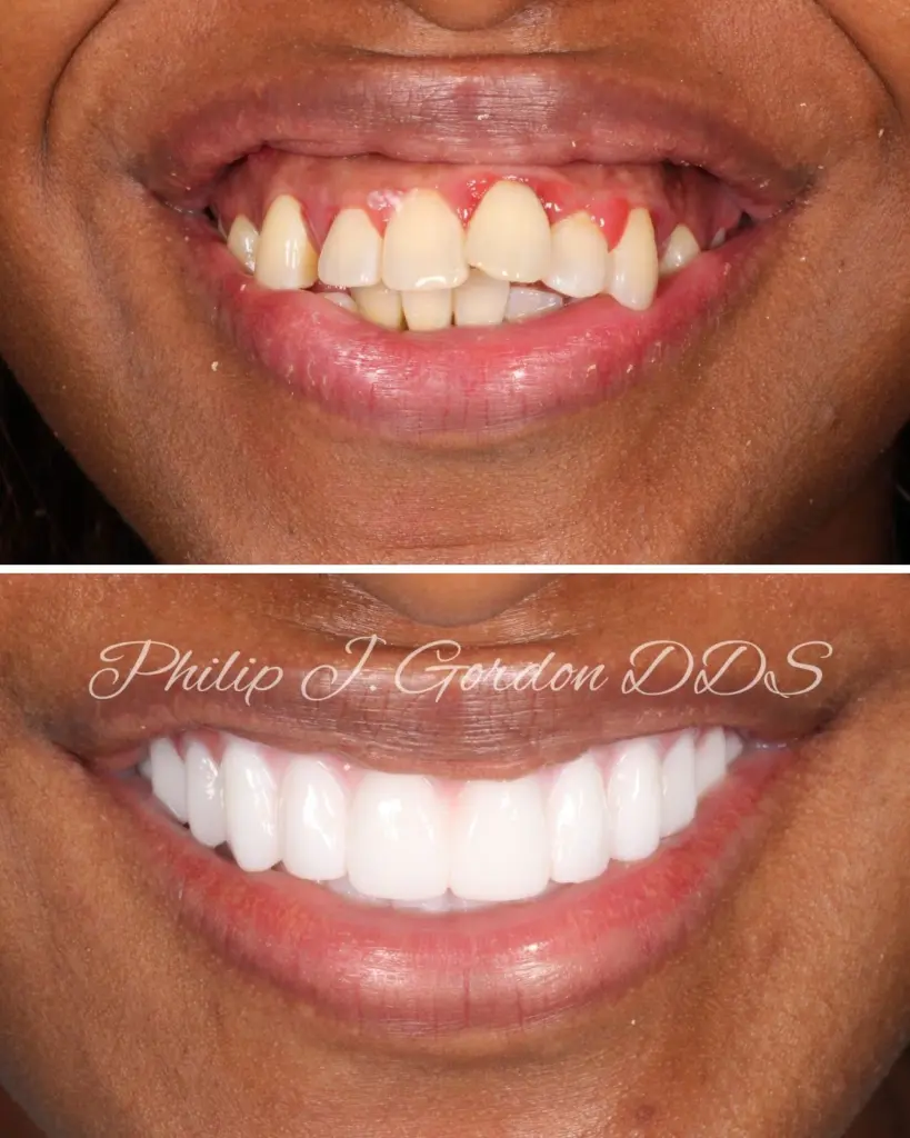 Full arch All-on-4 dental implants restoring a smile in Kansas City