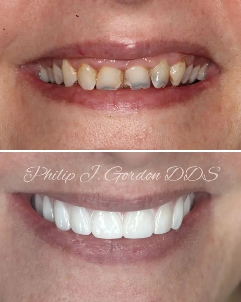 All-on-4 Dental Implants Kansas City Full Mouth Smile Makeover