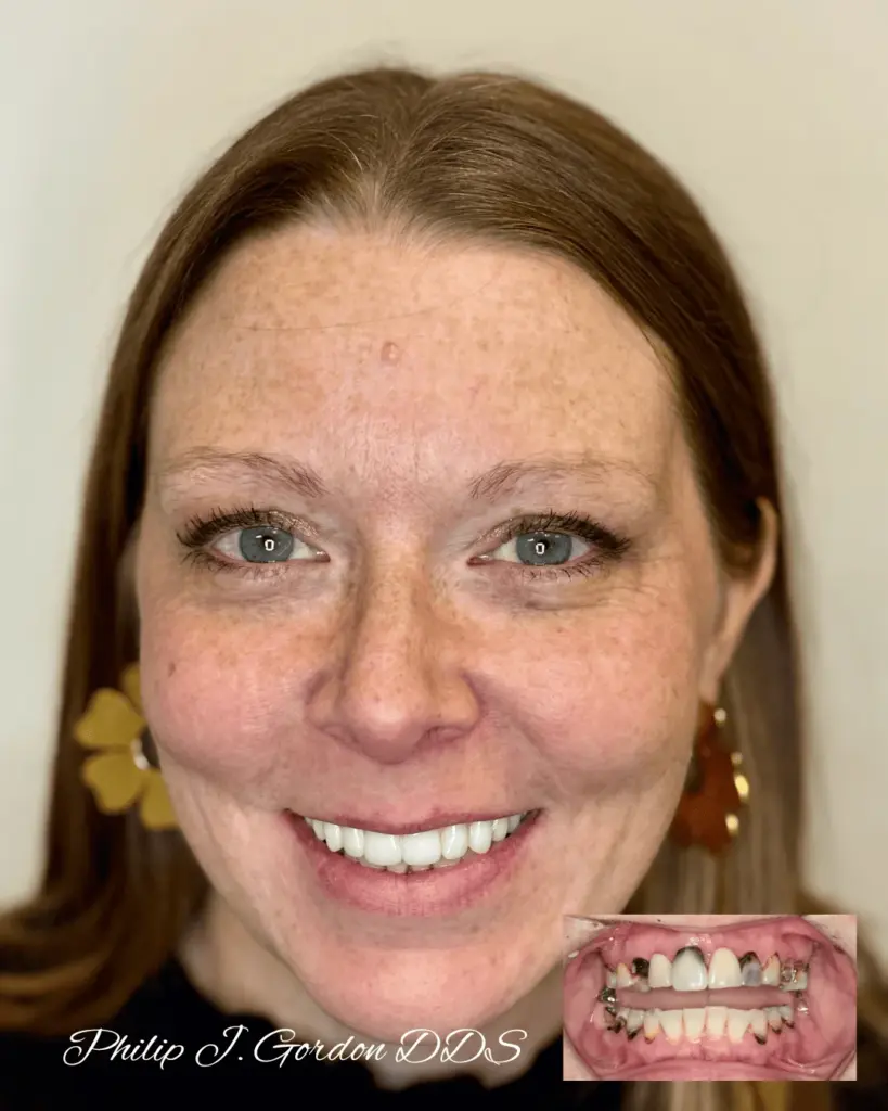 All-on-4 dental implants full mouth smile transformation showing fixed implant-supported teeth