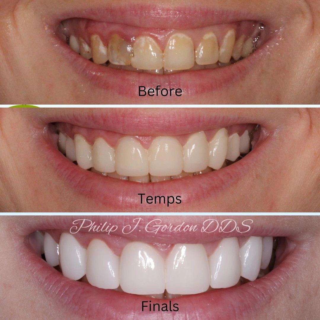 Before and after dental crown and veneer smile transformation in Kansas City
