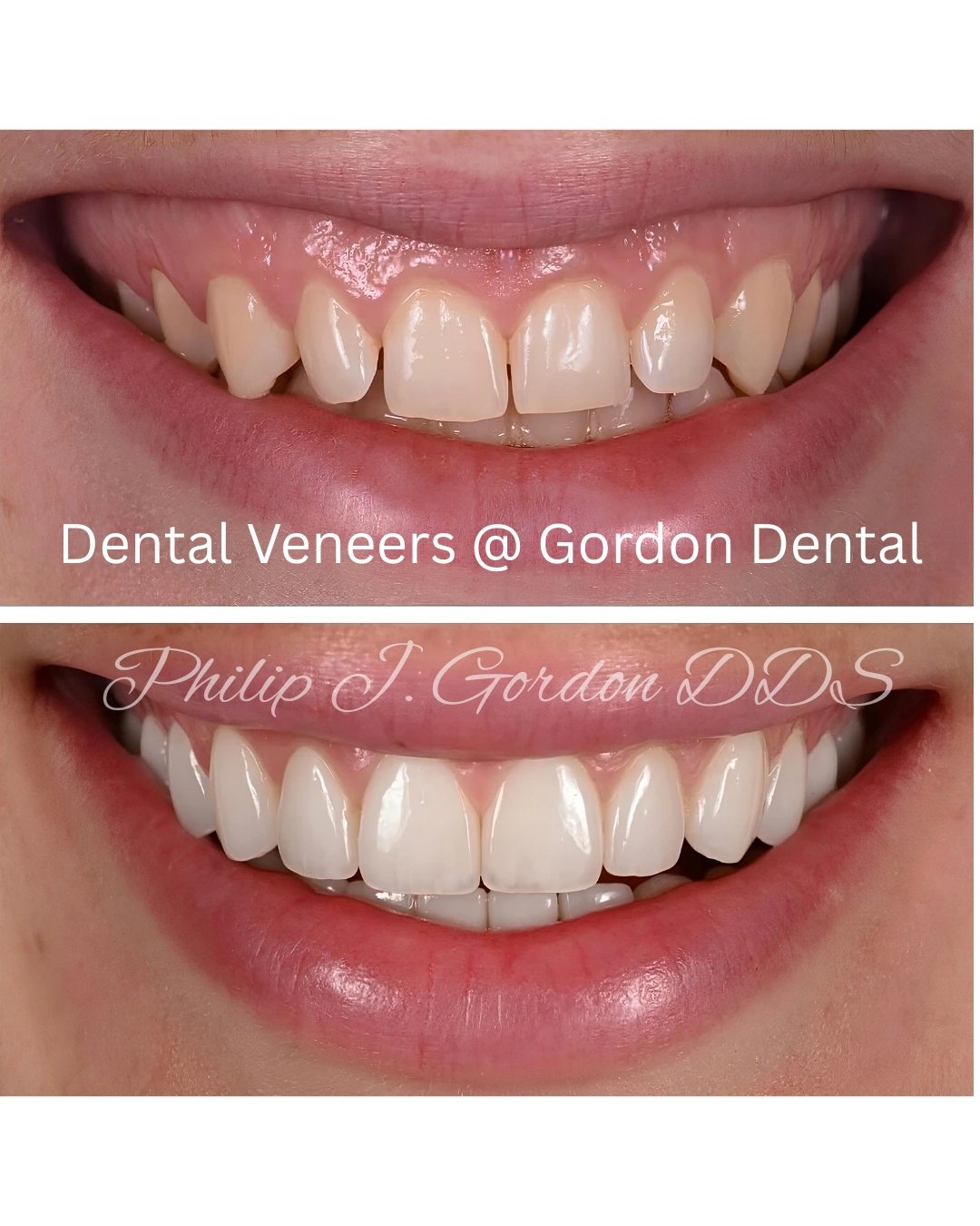 Porcelain veneers smile makeover treatment at Gordon Dental Implants and Cosmetics in Kansas City