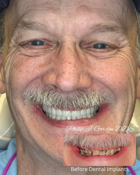 All-on-4 full mouth dental implants smile makeover in Kansas City