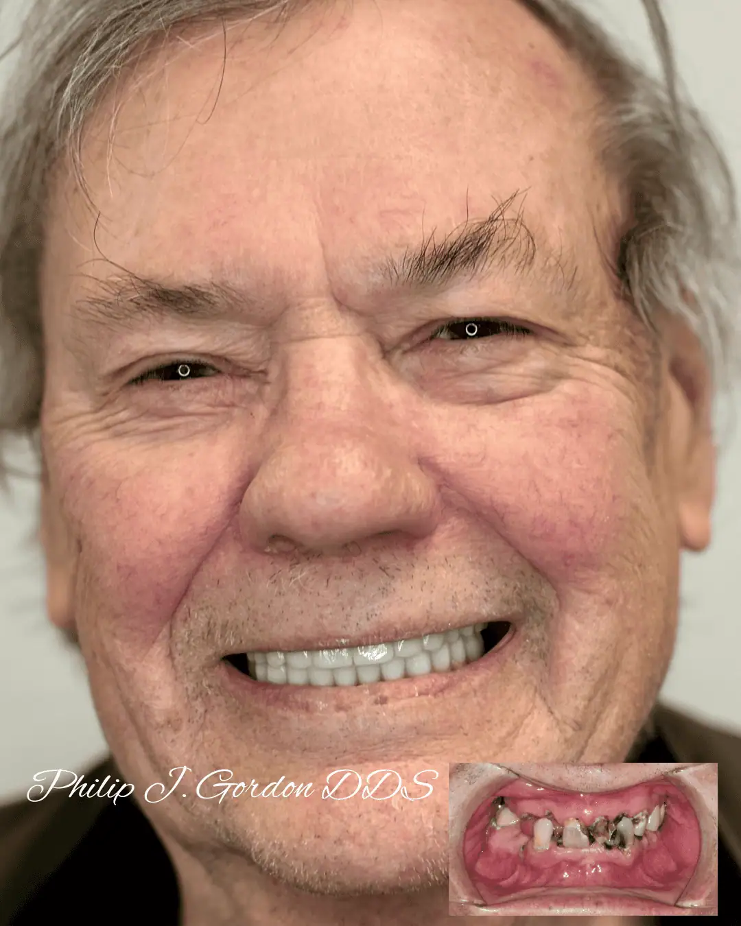 All-on-4 Dental Implants Kansas City at Gordon Dental Implants and Cosmetics
