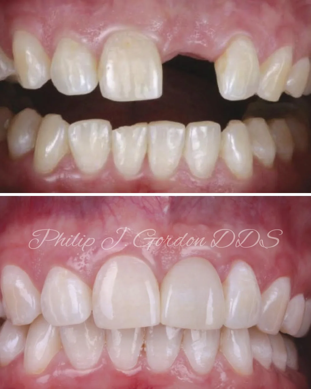 Front tooth dental implant smile restoration in Kansas City