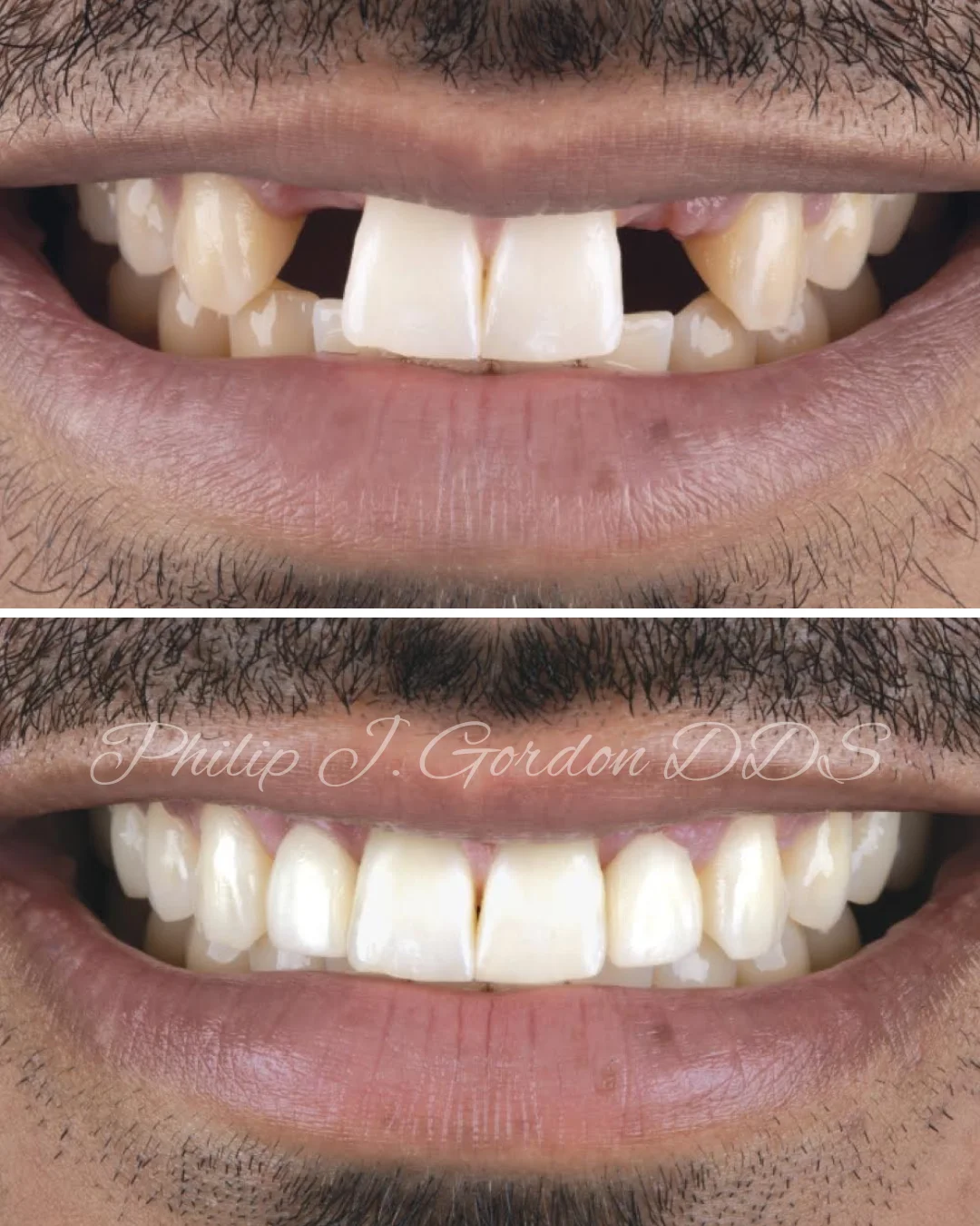 Dental implant restoration showing a titanium implant placed in the jawbone for missing tooth replacement