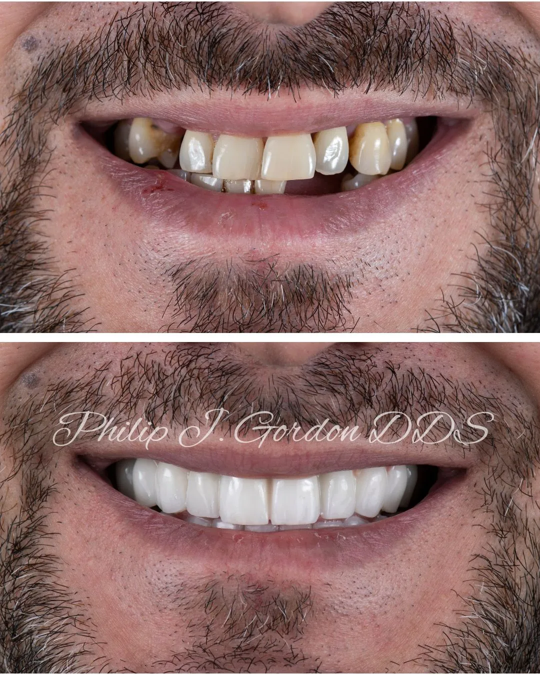 Reclaiming Your Life The Ultimate Guide to Full Mouth Dental Implants in Kansas City 2026