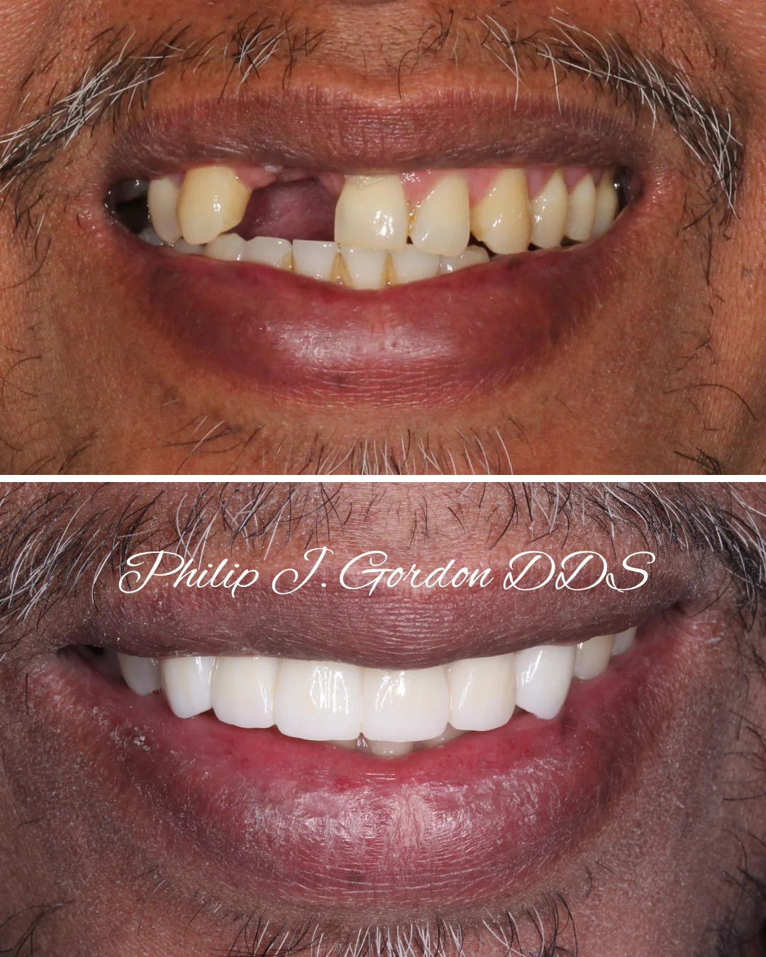 Dental Implants and Veneers for a Complete Smile Makeover in Kansas City