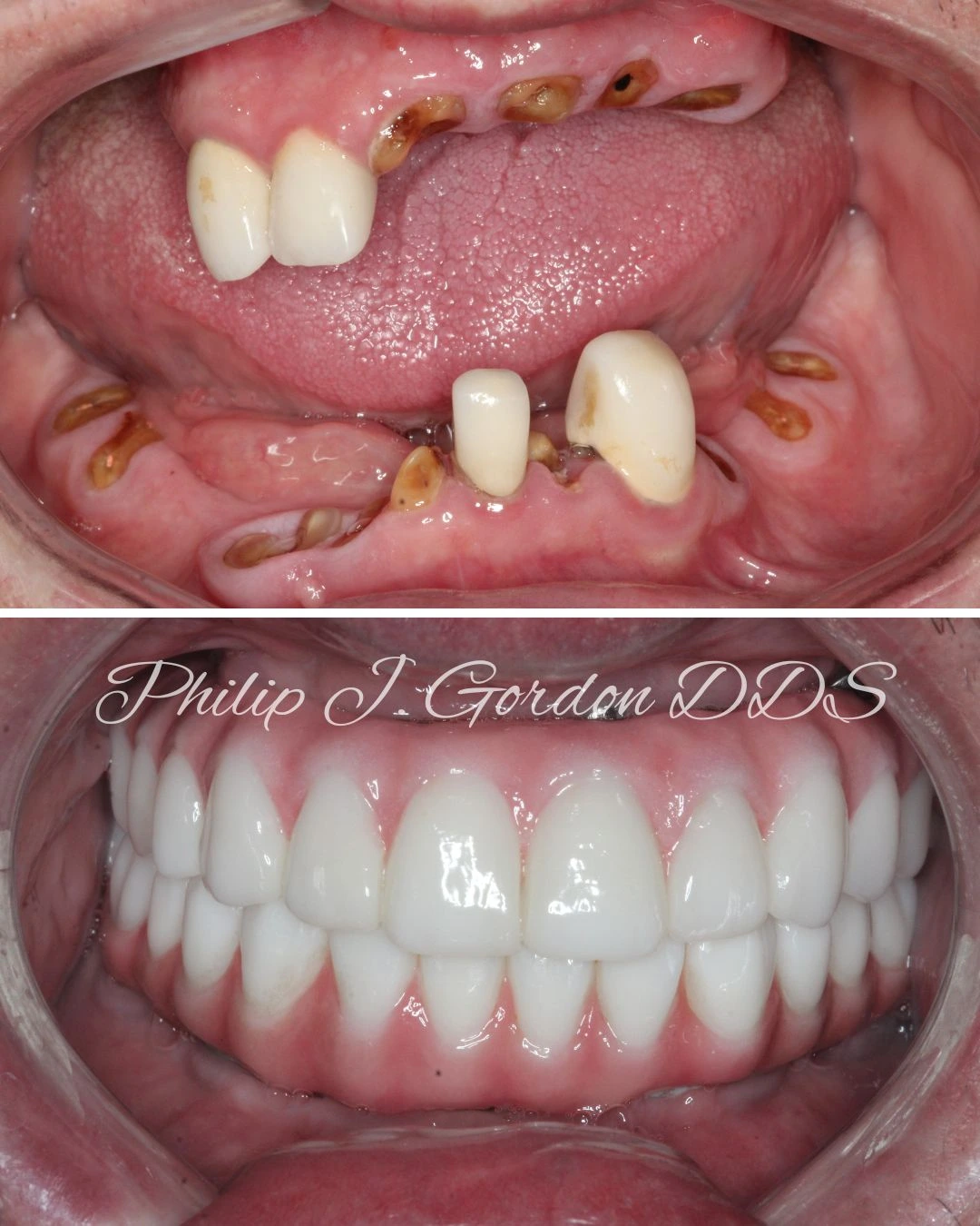 Fullmouth Dental implant Patient Before and After at Gordon Dental Implants
