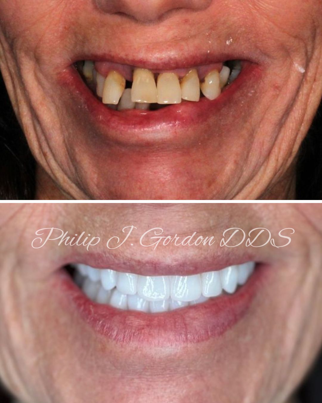 Before and after full mouth dental implants case completed by Dr. Philip Gordon, DDS, board-certified implant specialist in Kansas City, restoring a patient’s smile with full arch implant reconstruction.