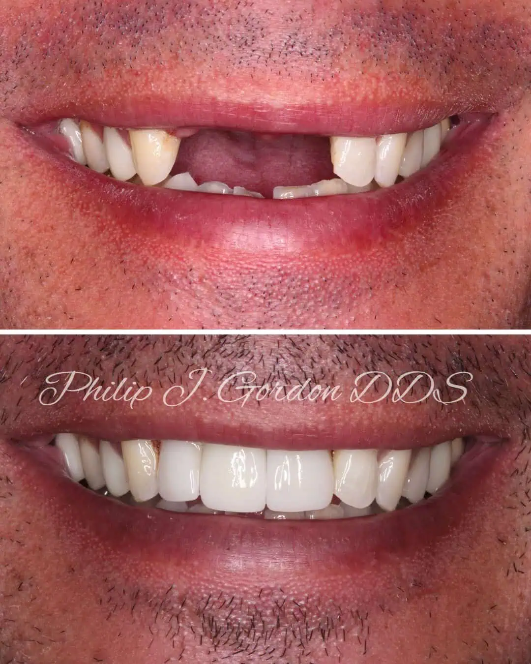 Dental implant smile restoration for missing teeth in Kansas City