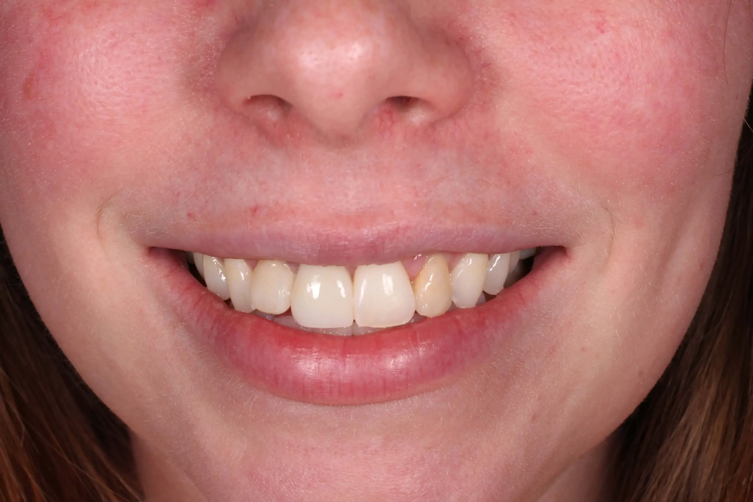Patient smile after cosmetic front tooth restoration in Kansas City