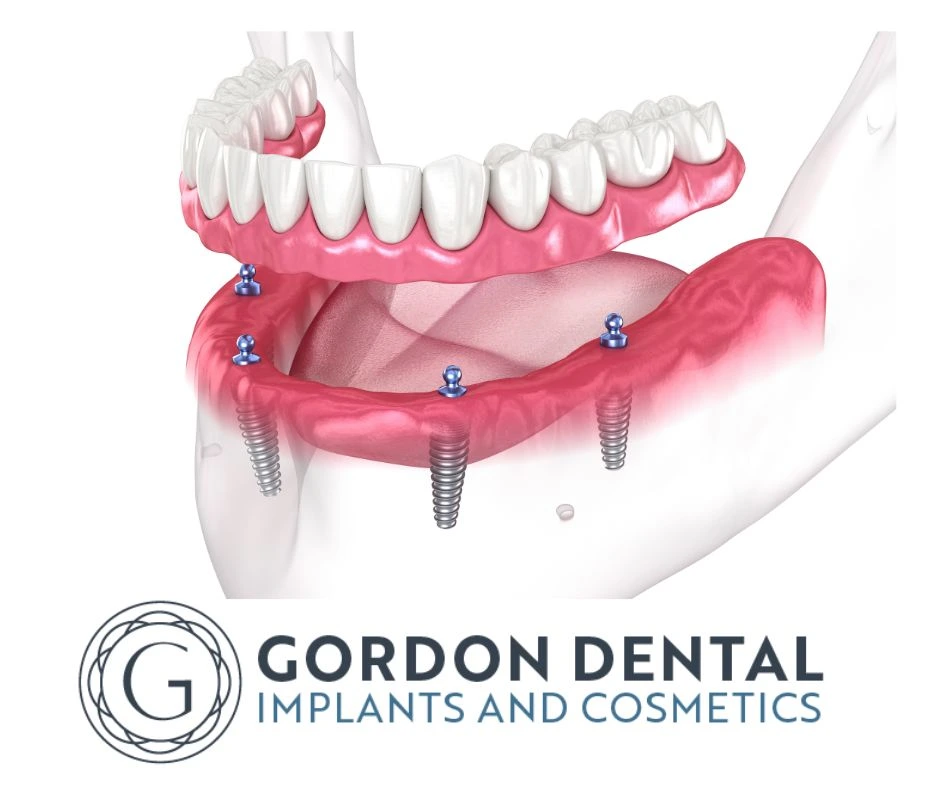 Dental implants used to replace missing teeth and restore a natural smile