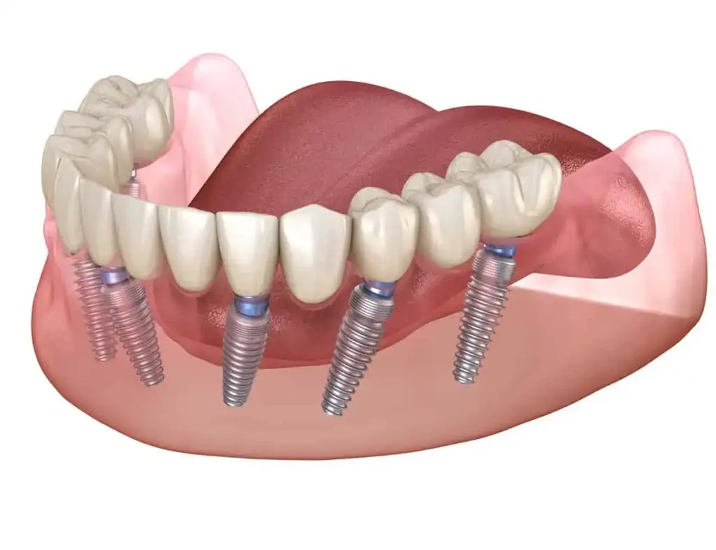 Full mouth dental implants restoring a complete smile
