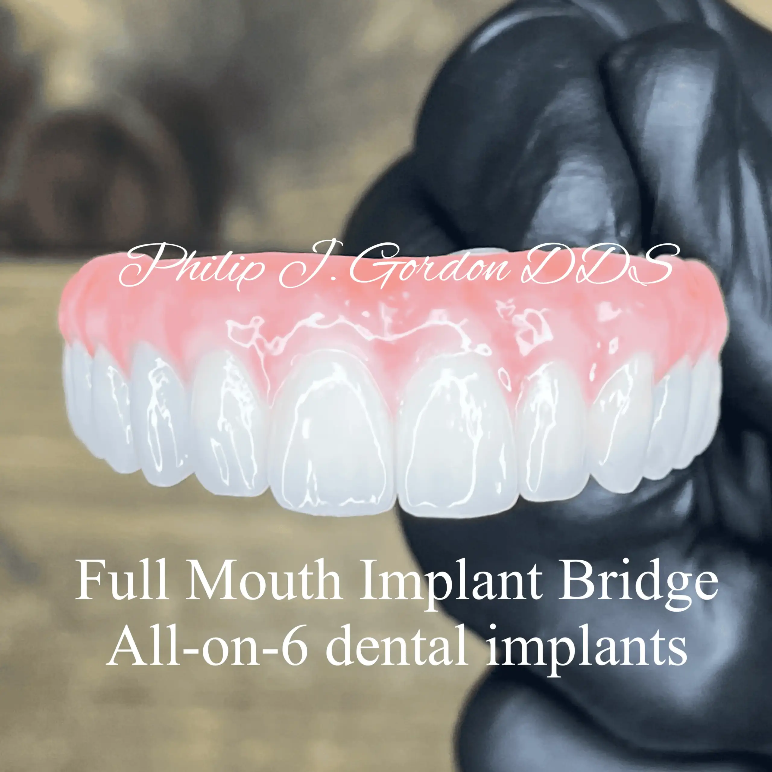Full Mouth Dental Implants