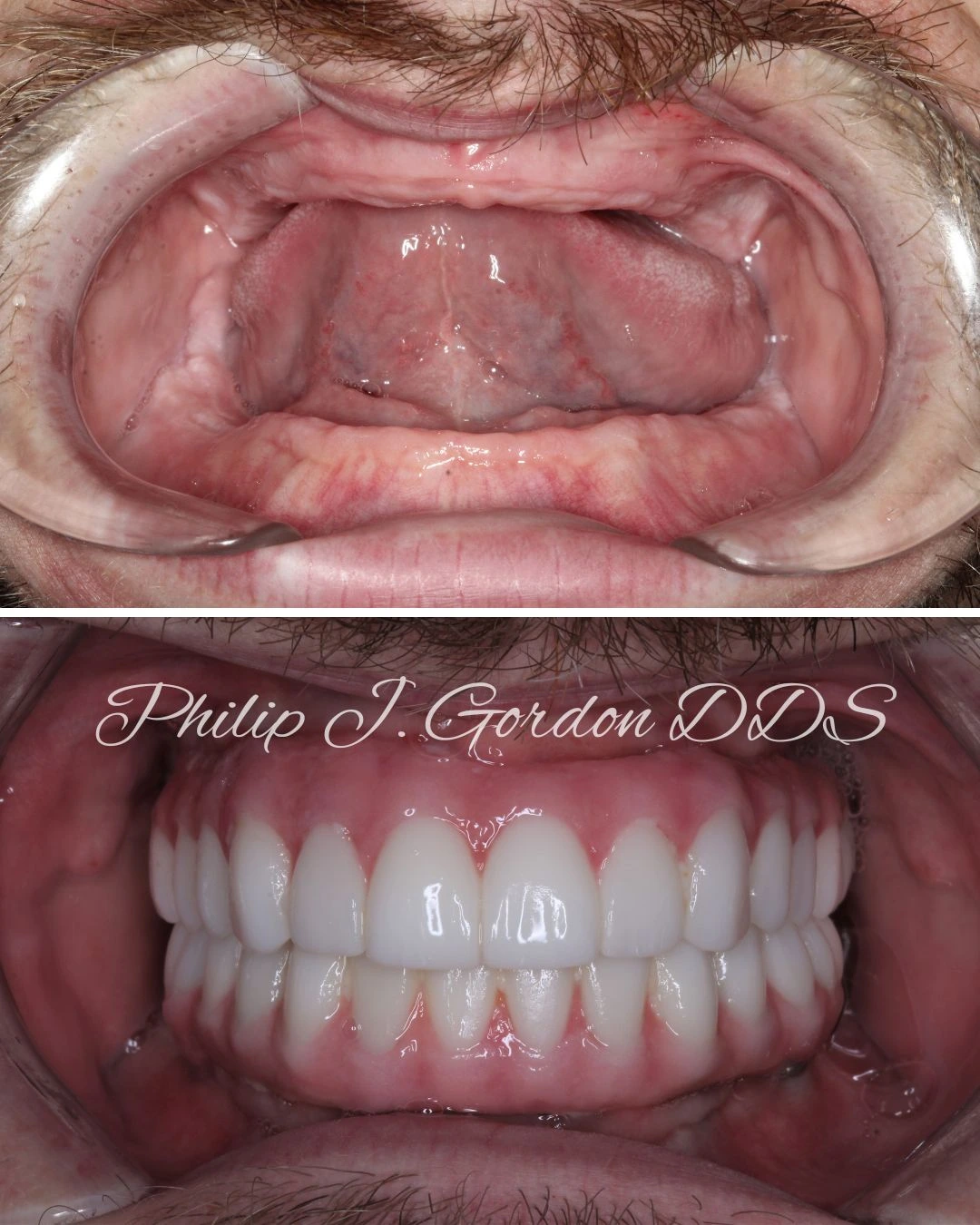 Full mouth dental implants restoring a complete smile