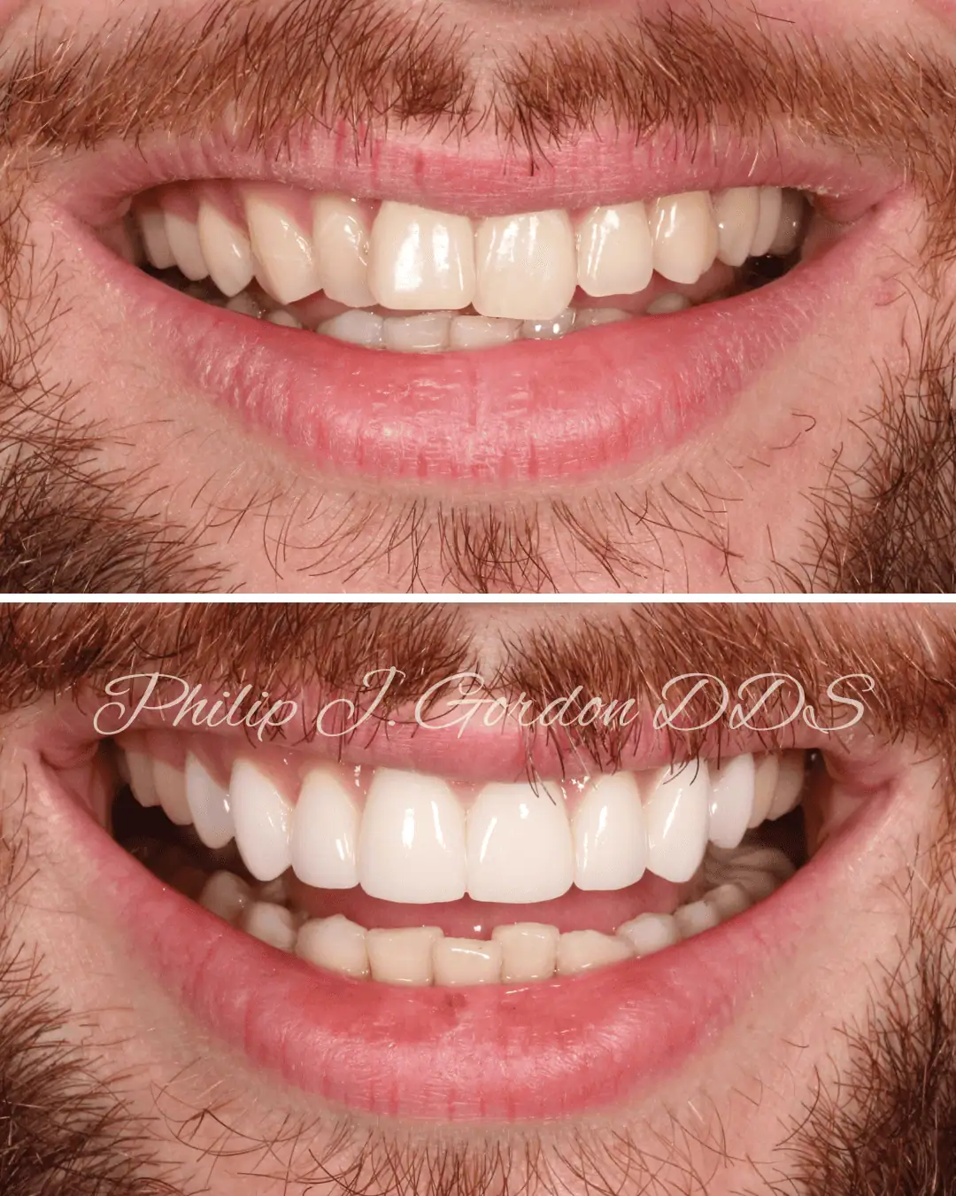 Before and after porcelain veneers smile transformation in Kansas City