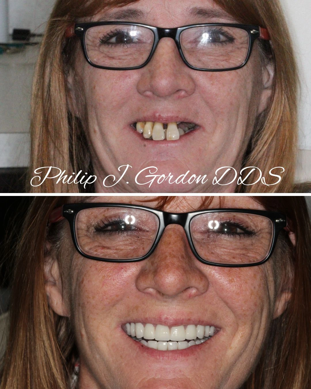 Before and after snap-on dental implants treatment for loose dentures