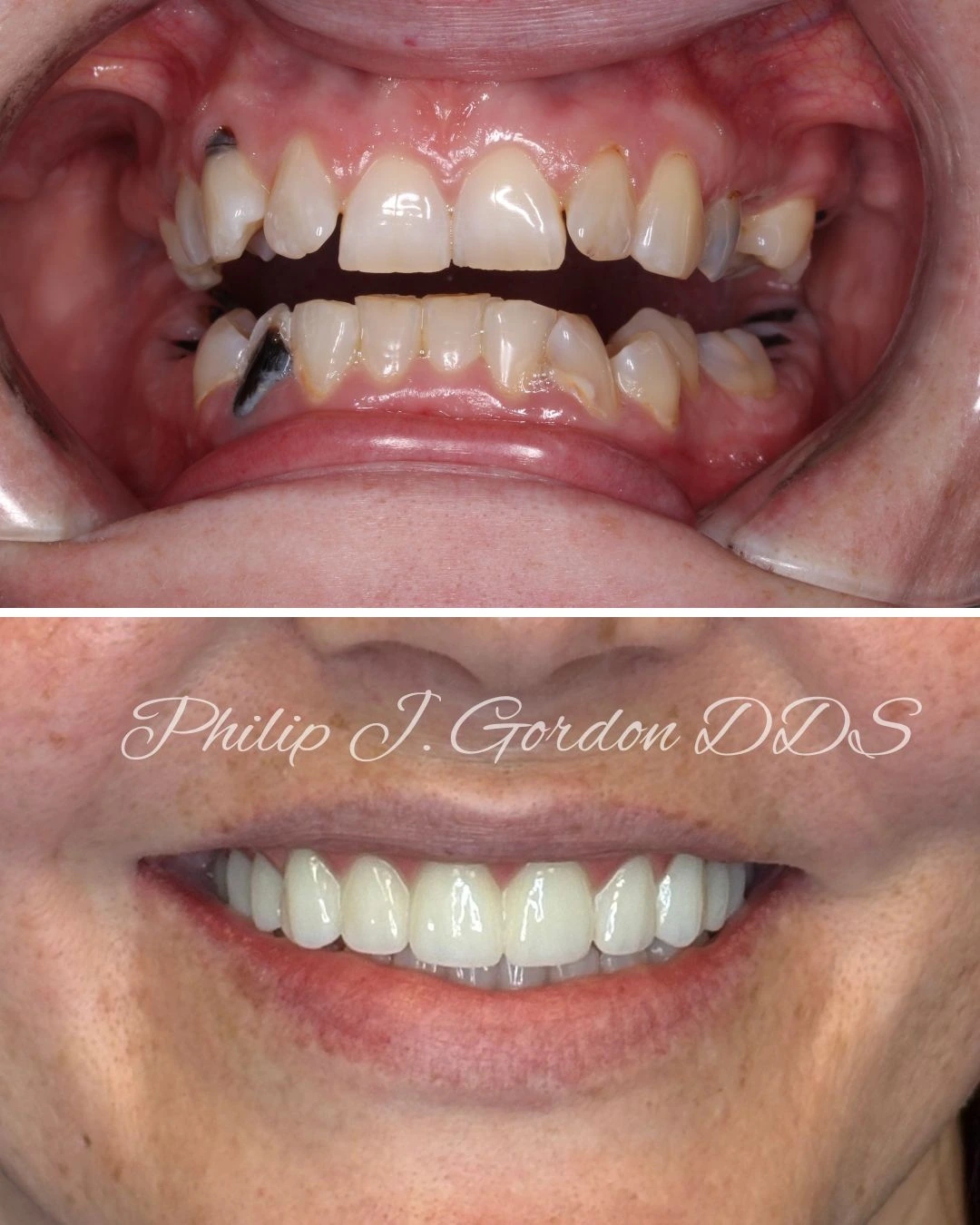 Before and after full mouth dental implants results at Gordon Dental Implants and Cosmetics in Kansas City