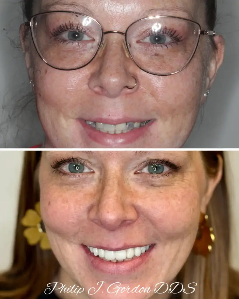 efore and after full arch dental implants Kansas City hybrid restoration