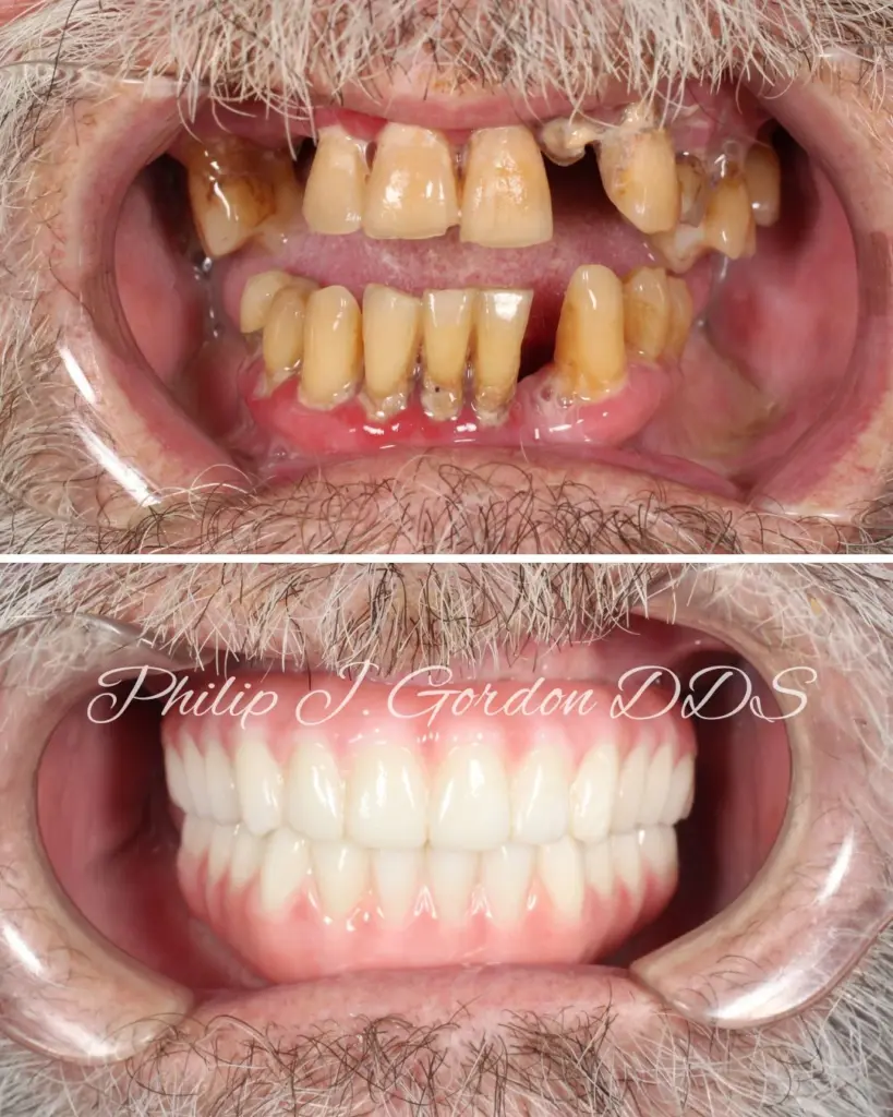 full mouth dental implants before and after Kansas City All-on-4 case study