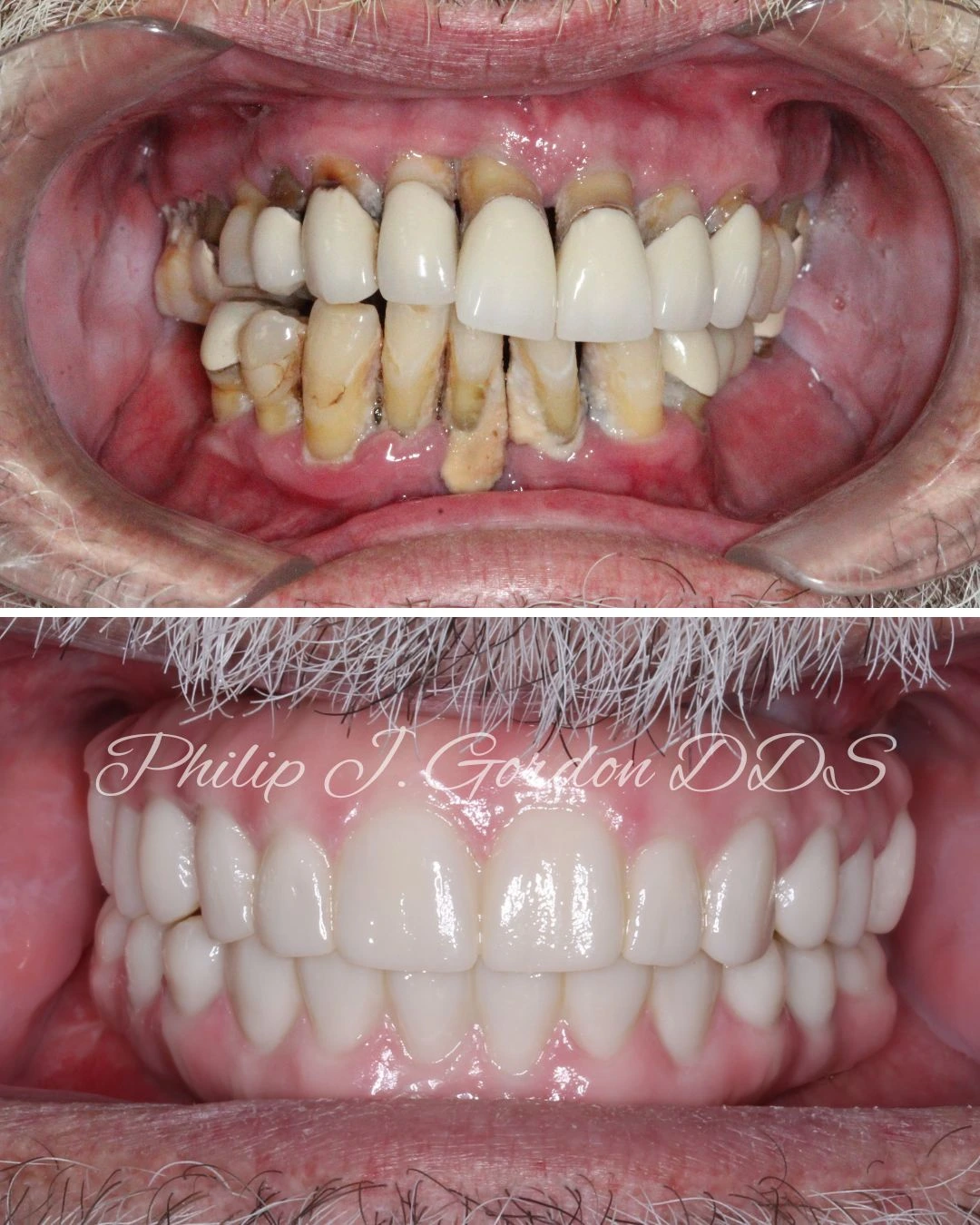 full-arch dental implants at Gordon Dental Implants and Cosmetics