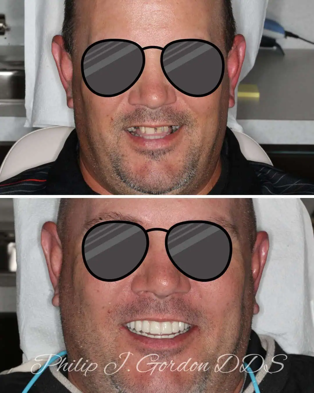 Full Mouth Smile Transformation in Kansas City