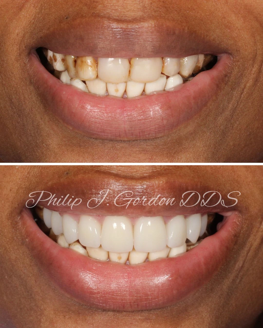 Before and after porcelain veneers for deep tooth discoloration in Kansas City patient