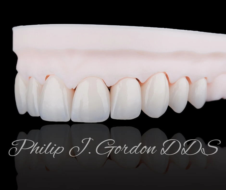 Cosmetic smile makeover using porcelain veneers to repair chipped teeth